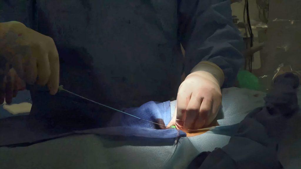 CSS: Más catéteres para diálisis peritoneal