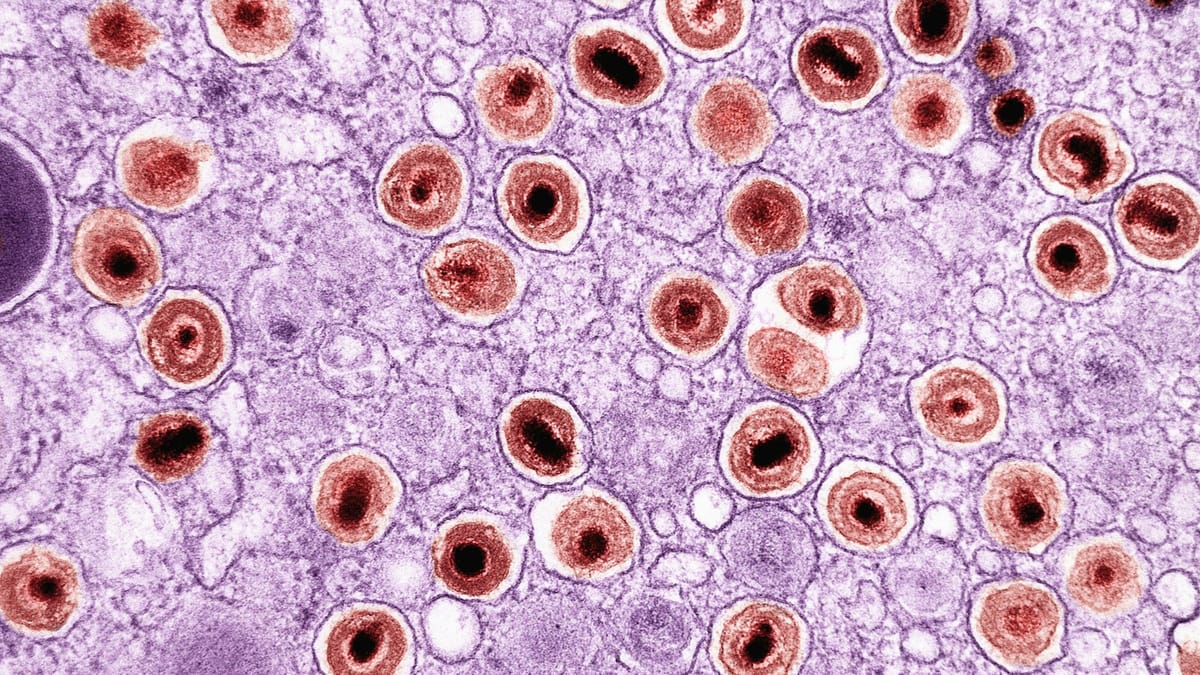 Desarrollan bioadhesivo inspirado en mejillones que elimina células de tumor cerebral letal